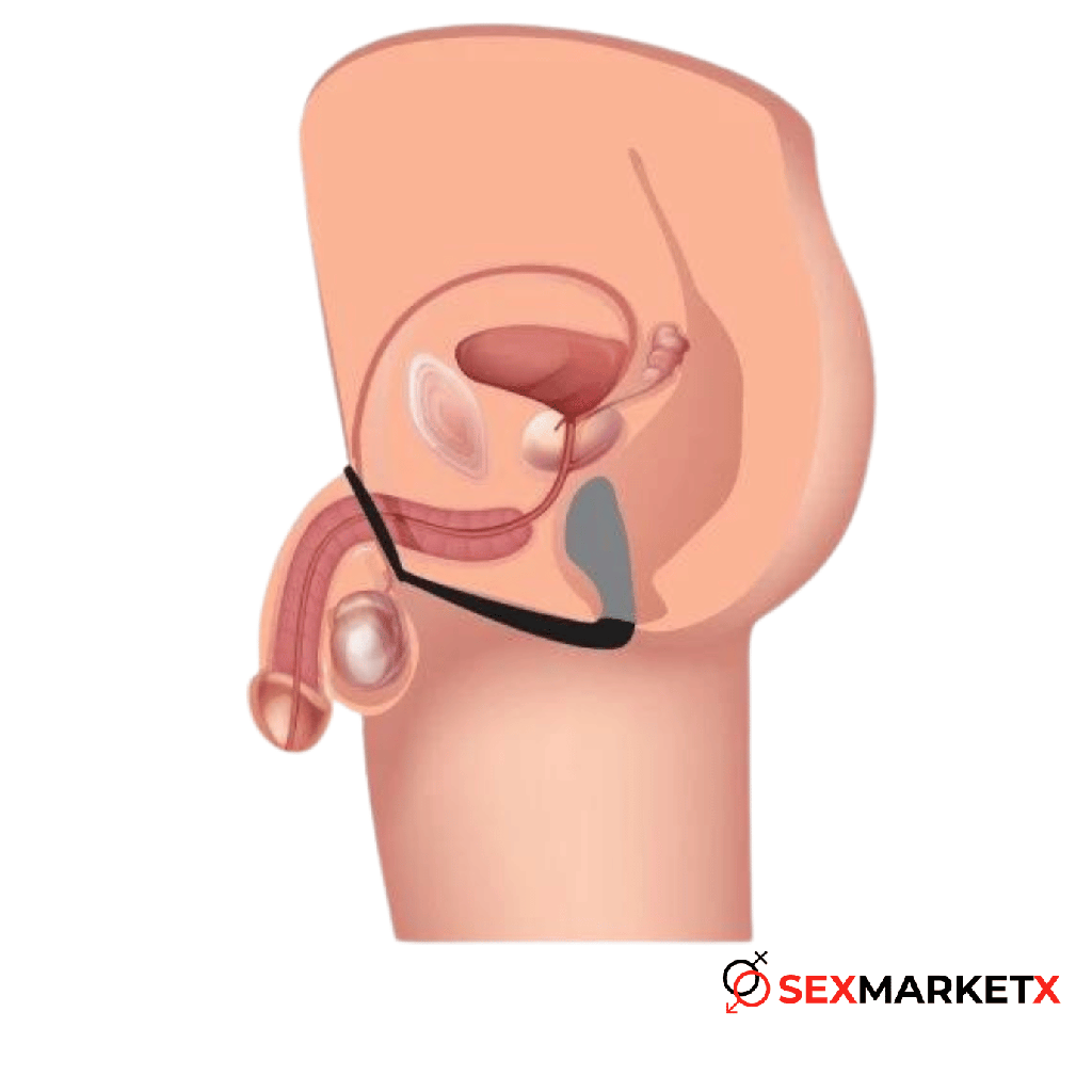 Anillo estimulador de prostata instalación