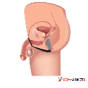 Anillo estimulador de prostata instalación
